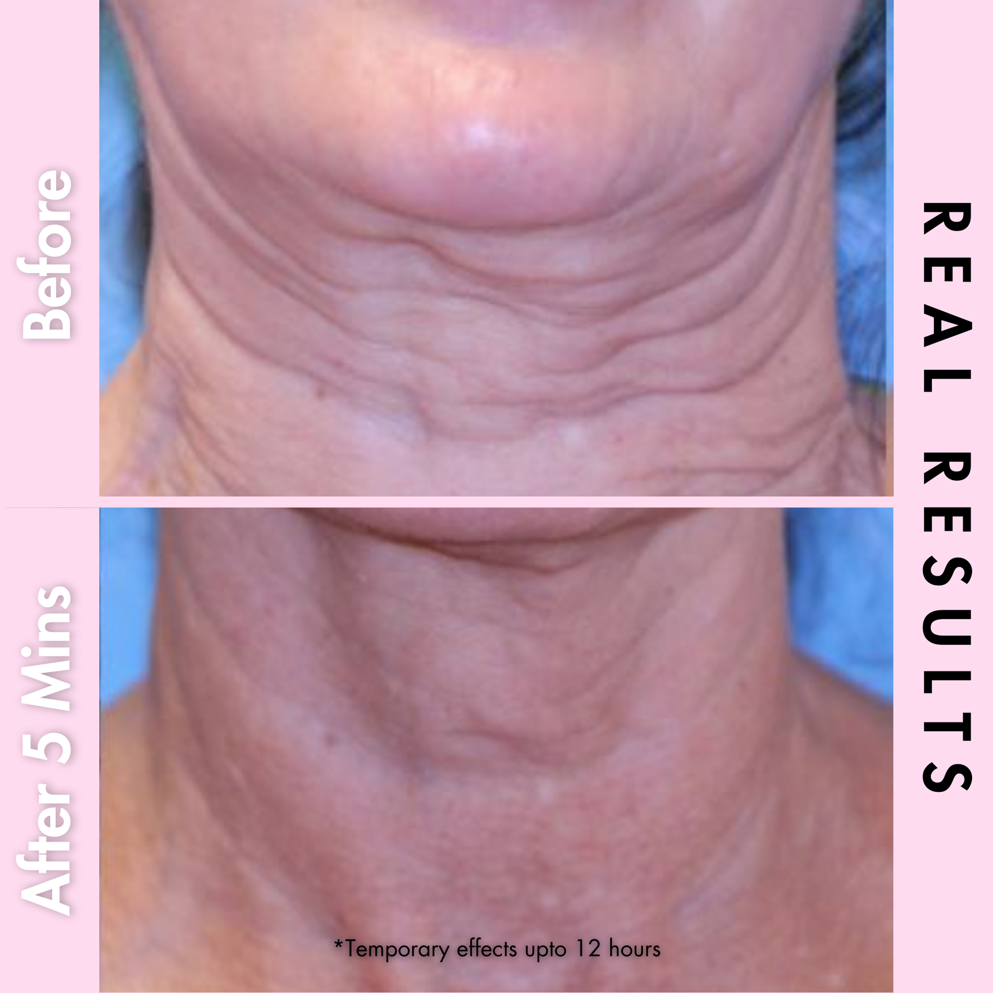 neck firming by  dr crazy results